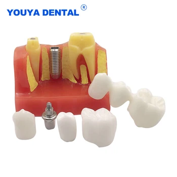  Dantų Modelis 4 Kartus Dervos Danties Implantas Modelis Mokosi Mokymo Modulio Medicinos Mokslo Burnos, Odontologija, Stomatologas Produktus